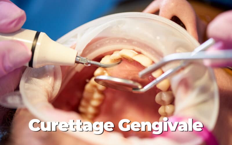 Curettage Gengivale e Levigatura Radicolare: Il segreto per sconfiggere la parodontite