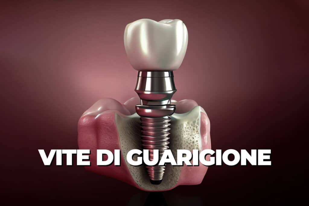 vite di guarigione impianti dentali