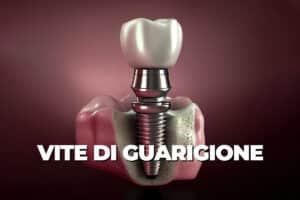 vite di guarigione impianti dentali