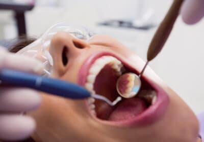 devitalizzare dente