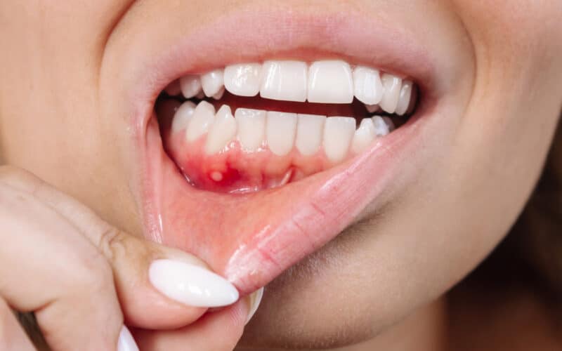 Fistola dentale: cos’è e come curarla