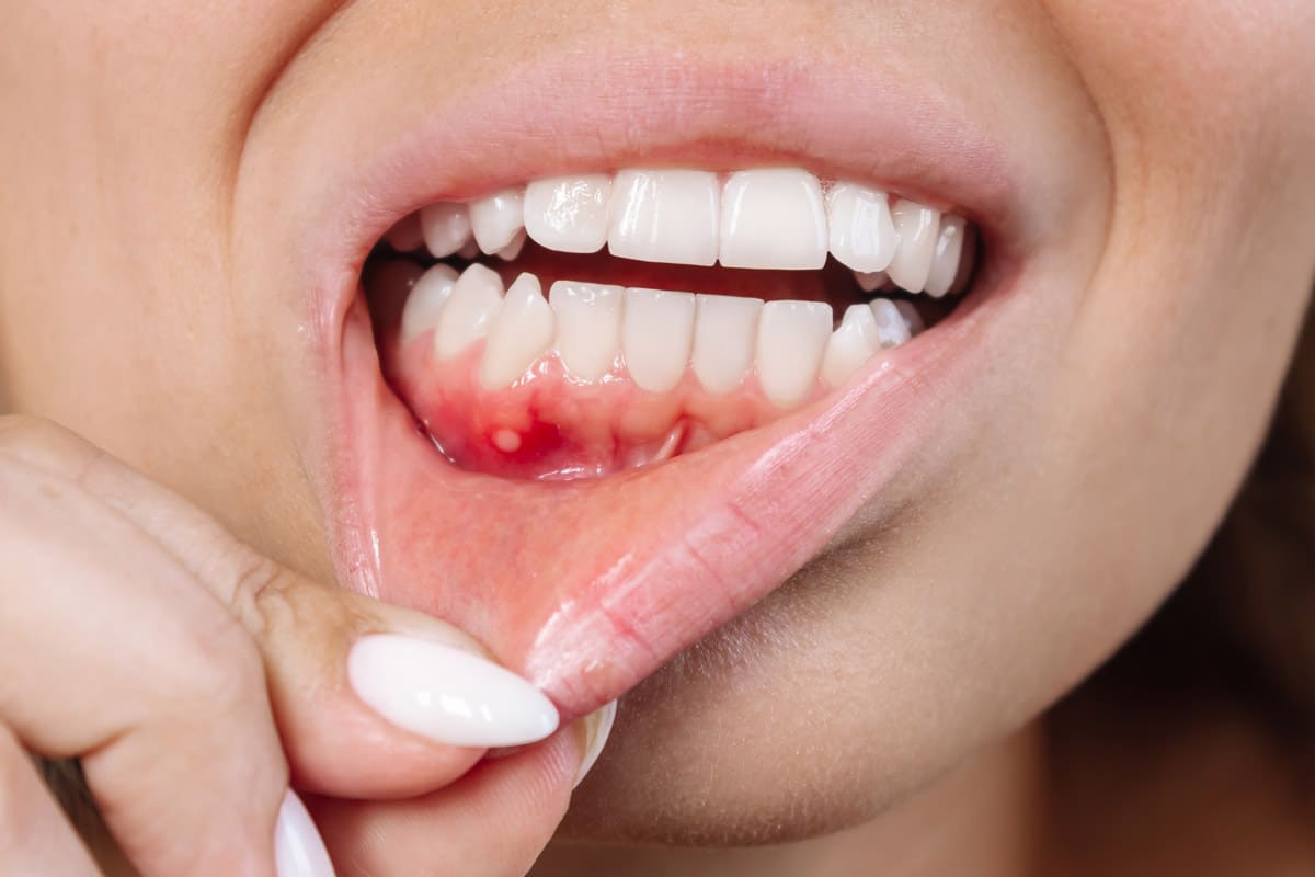 Fistola dentale e gengivale: perché compare la pallina sulla gengiva e come si cura