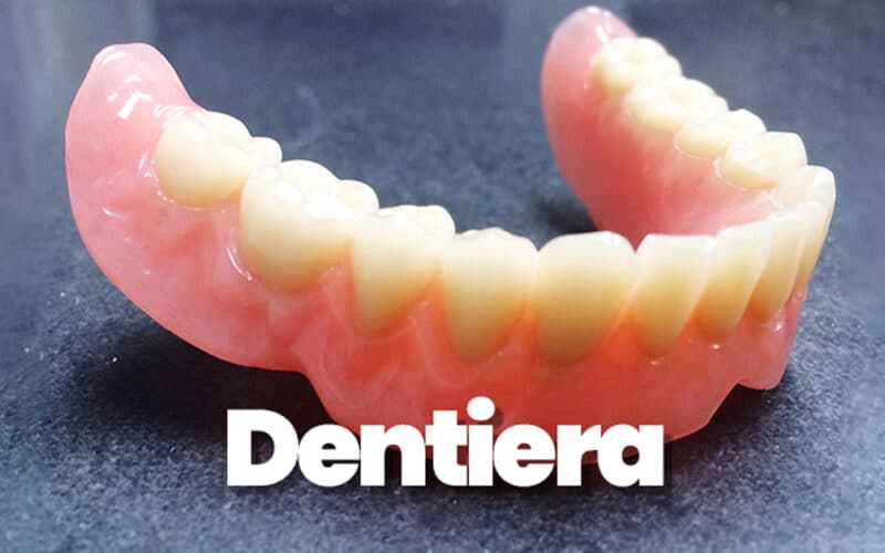 Dentiera: guida completa per vivere con la protesi mobile