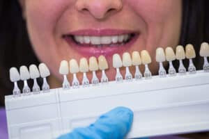 costo faccette dentali