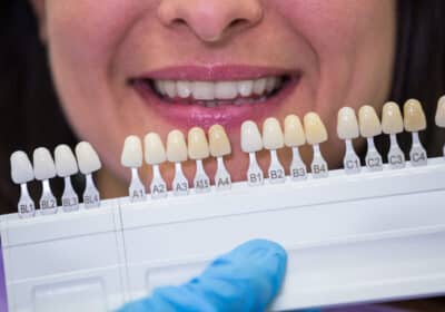 costo faccette dentali