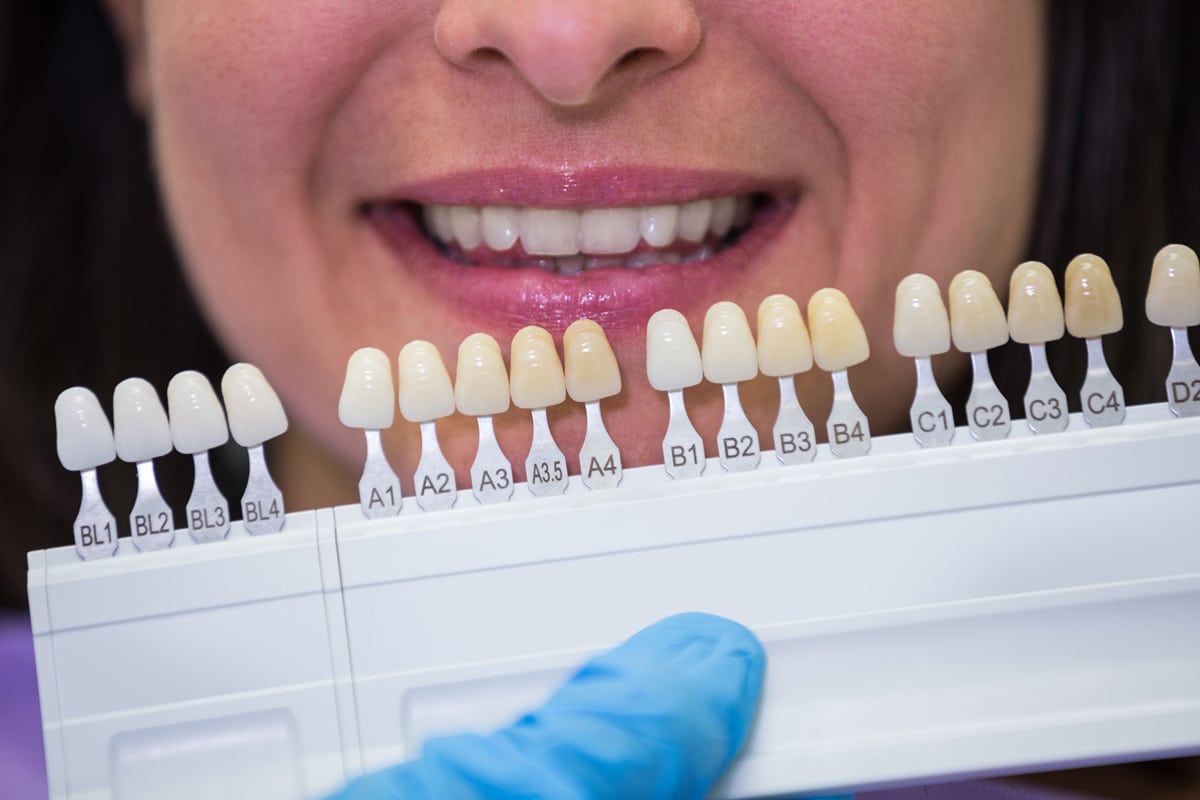 Costo delle faccette dentali: da cosa dipende il prezzo per dente