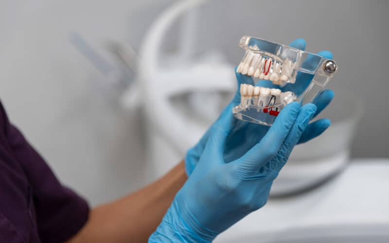 Quanti denti si possono mettere su un impianto
