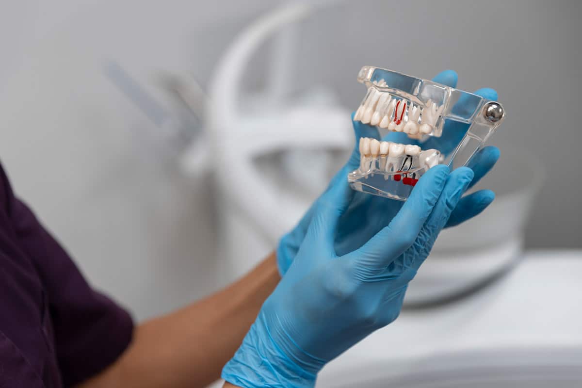 Quanti denti regge un impianto e quanti impianti servono per arcata