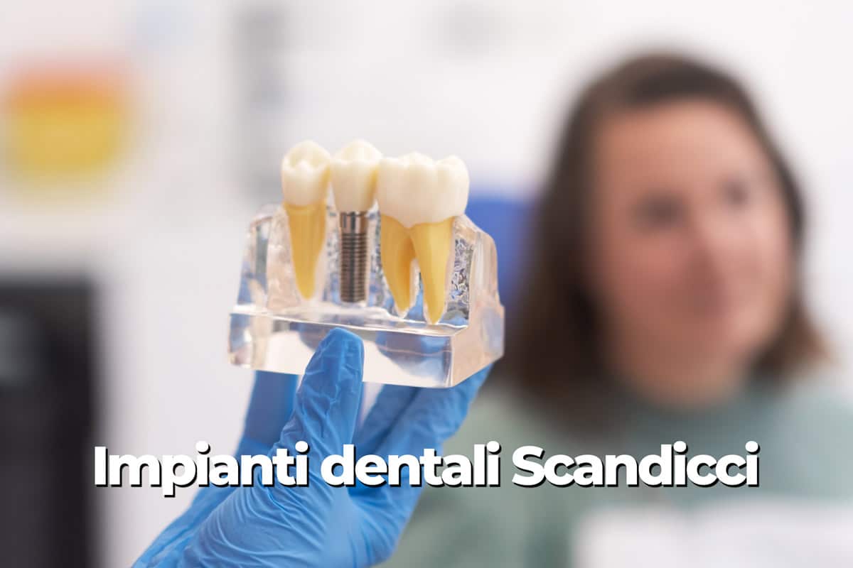 Impianti dentali Scandicci: sorriso fisso in 24-48h