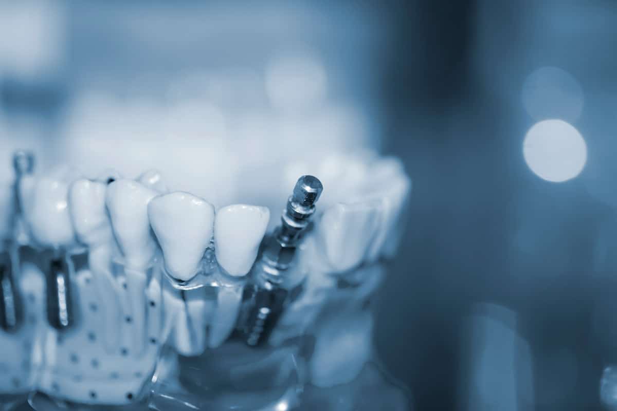 Impianti dentali corti e ultra-corti: la guida completa alla chirurgia implantare mininvasiva