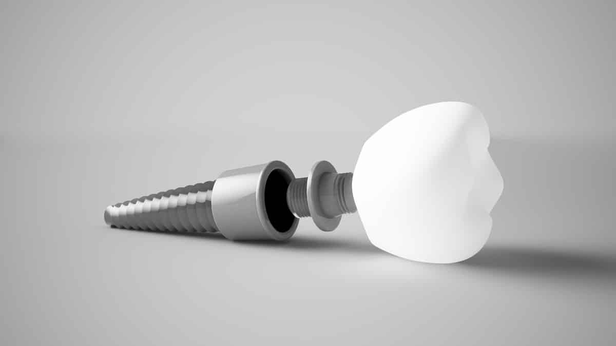 Stabilità primaria e secondaria: il cuore del successo implantare